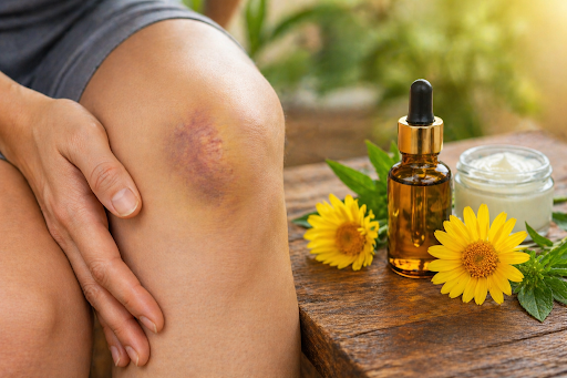 Does Arnica Reduce Bruising and Swelling?